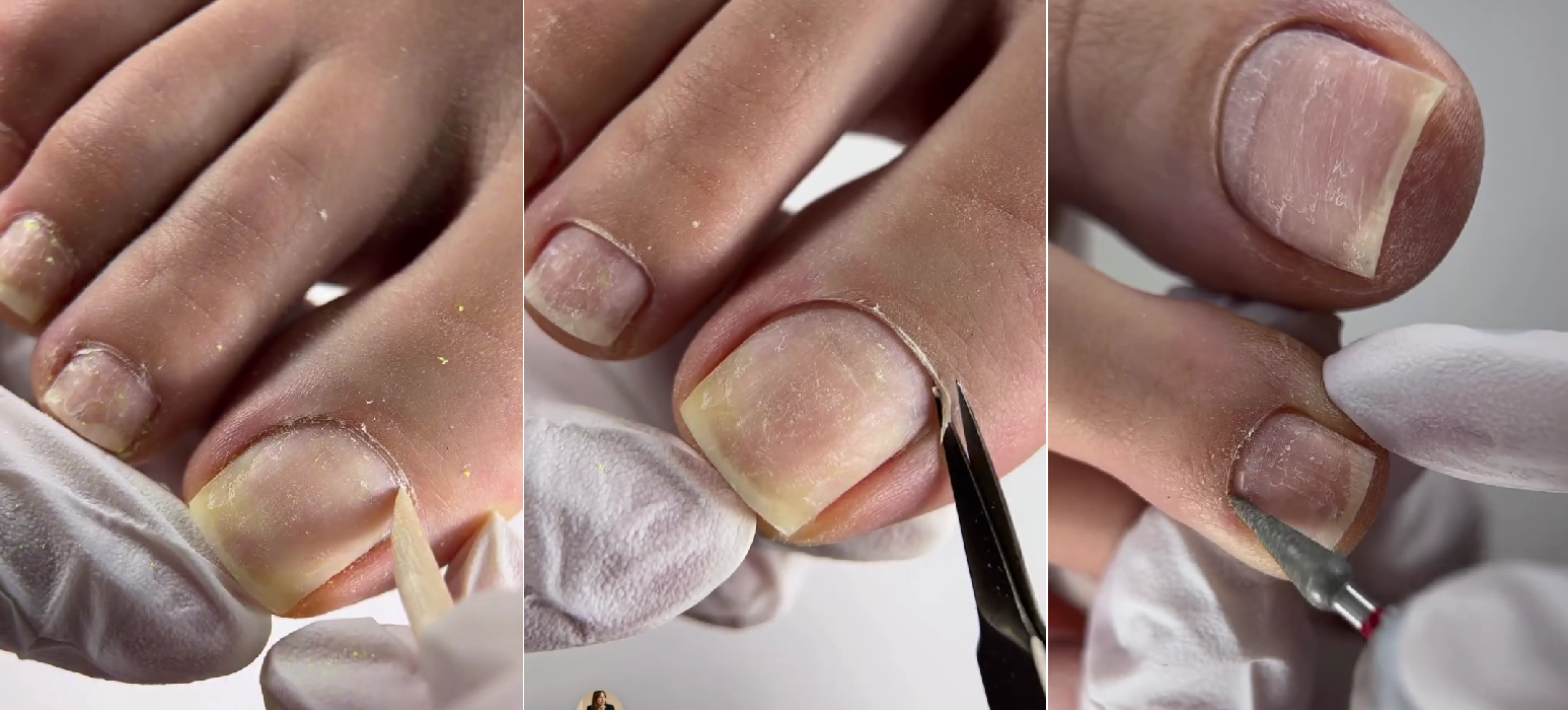 @podolog_regina Konoshonok Regina is a pedicurist from Russia. Natural toenails.